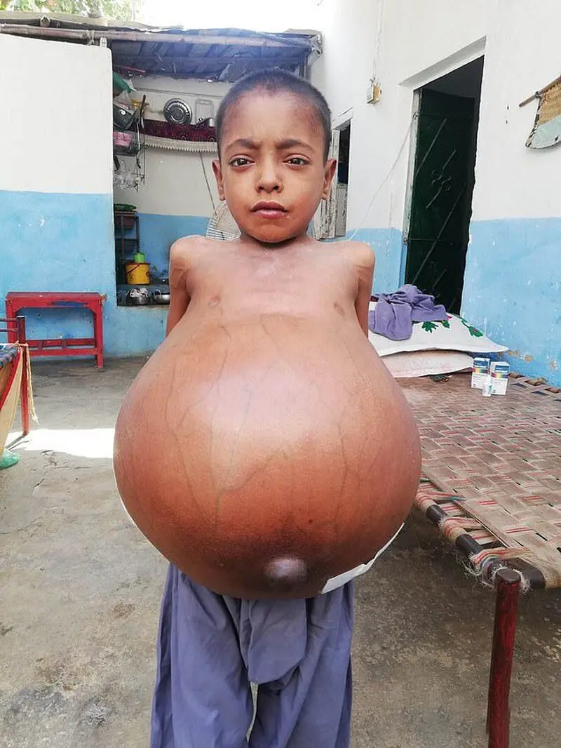 تورم غیرطبیعی شکم پسر ۹ ساله خبرساز شد