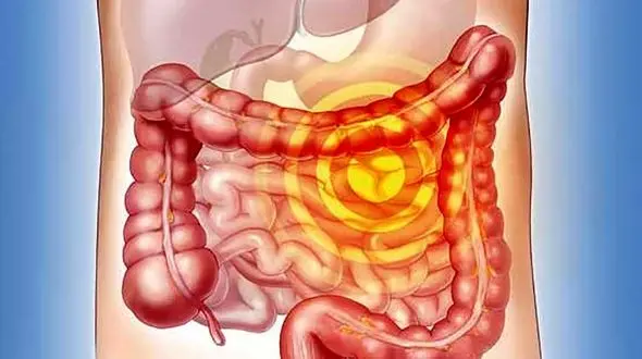 5 نشانه جدی سرطان روده بزرگ
