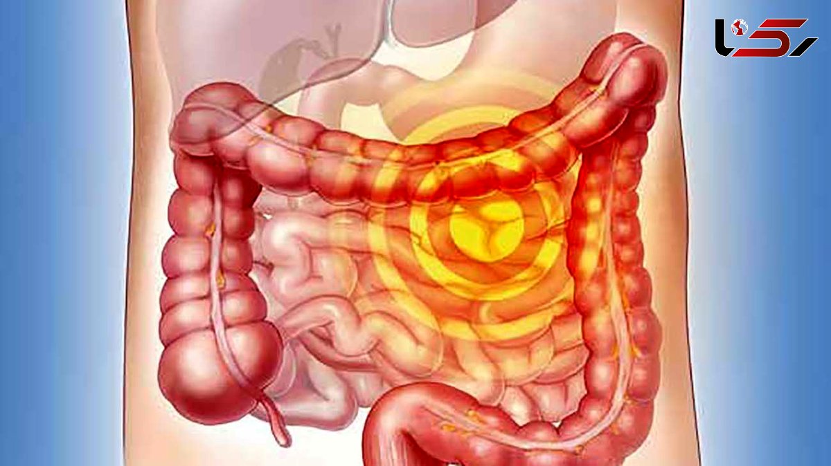 5 نشانه جدی سرطان روده بزرگ