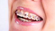 افزایش پوسیدگی دندان با لمینیت و کامپوزیت