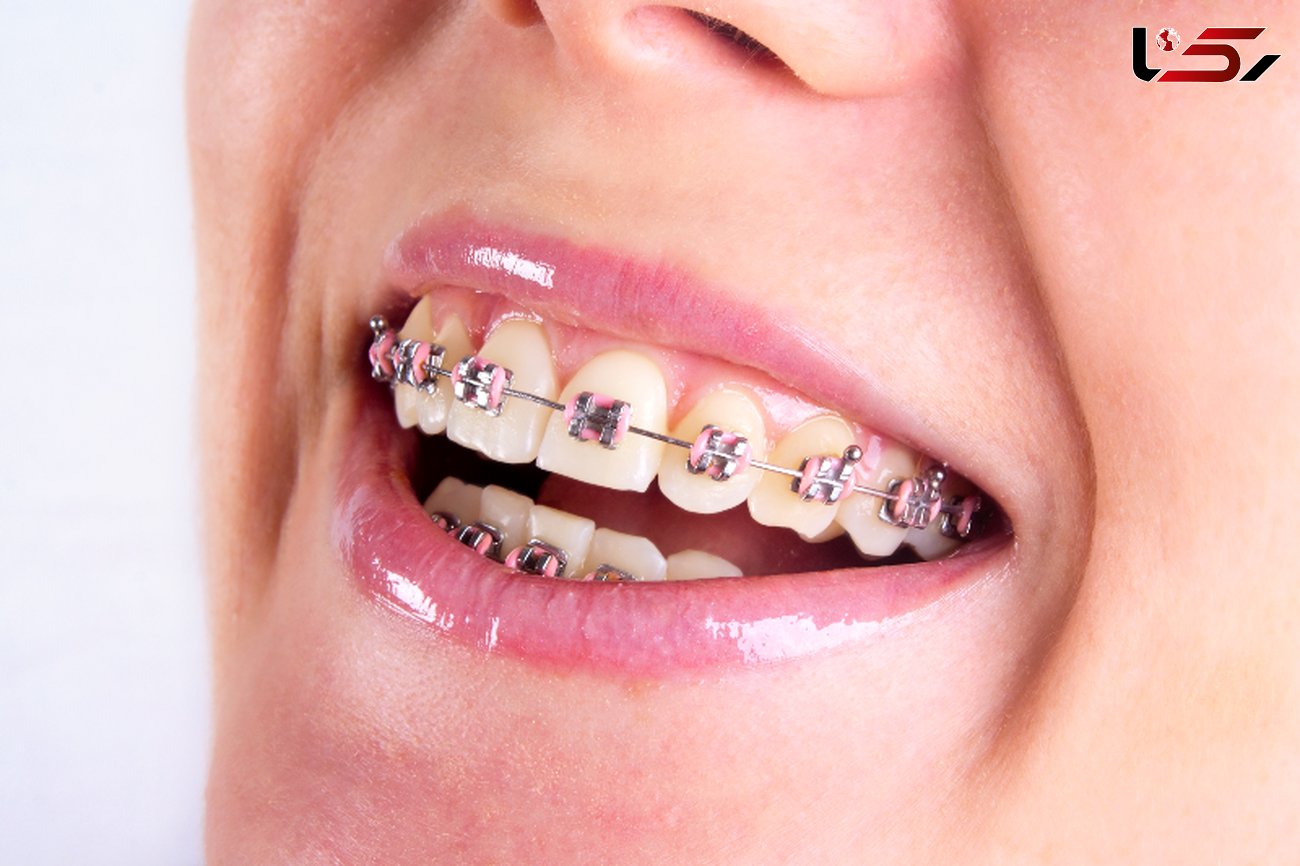 افزایش پوسیدگی دندان با لمینیت و کامپوزیت