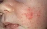 گسترش سرخک در ایران / وزارت بهداشت : اتباع افغانستانی تازه وارد واکسن سرخک بزنند 