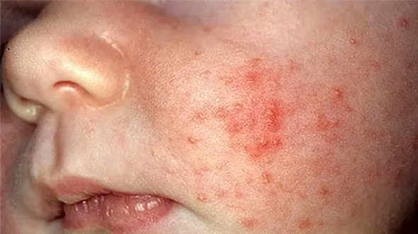 گسترش سرخک در ایران / وزارت بهداشت : اتباع افغانستانی تازه وارد واکسن سرخک بزنند 