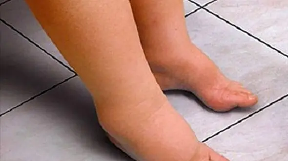 «لنف اِدِم» چیست؟