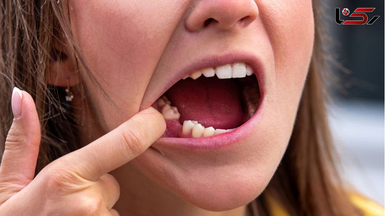 New long Covid side effect as dentists warn some patients' teeth are suddenly falling out