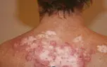 بحران دارویی بیماران لوپوس/ بیماران مجبور به استفاده از داروهای ایرانی با تأثیر کمتر و قیمت‌های نجومی در بازار آزاد