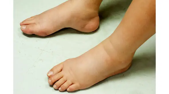 7 دلیل تورم پا/چرا نباید کفش تنگ پوشید