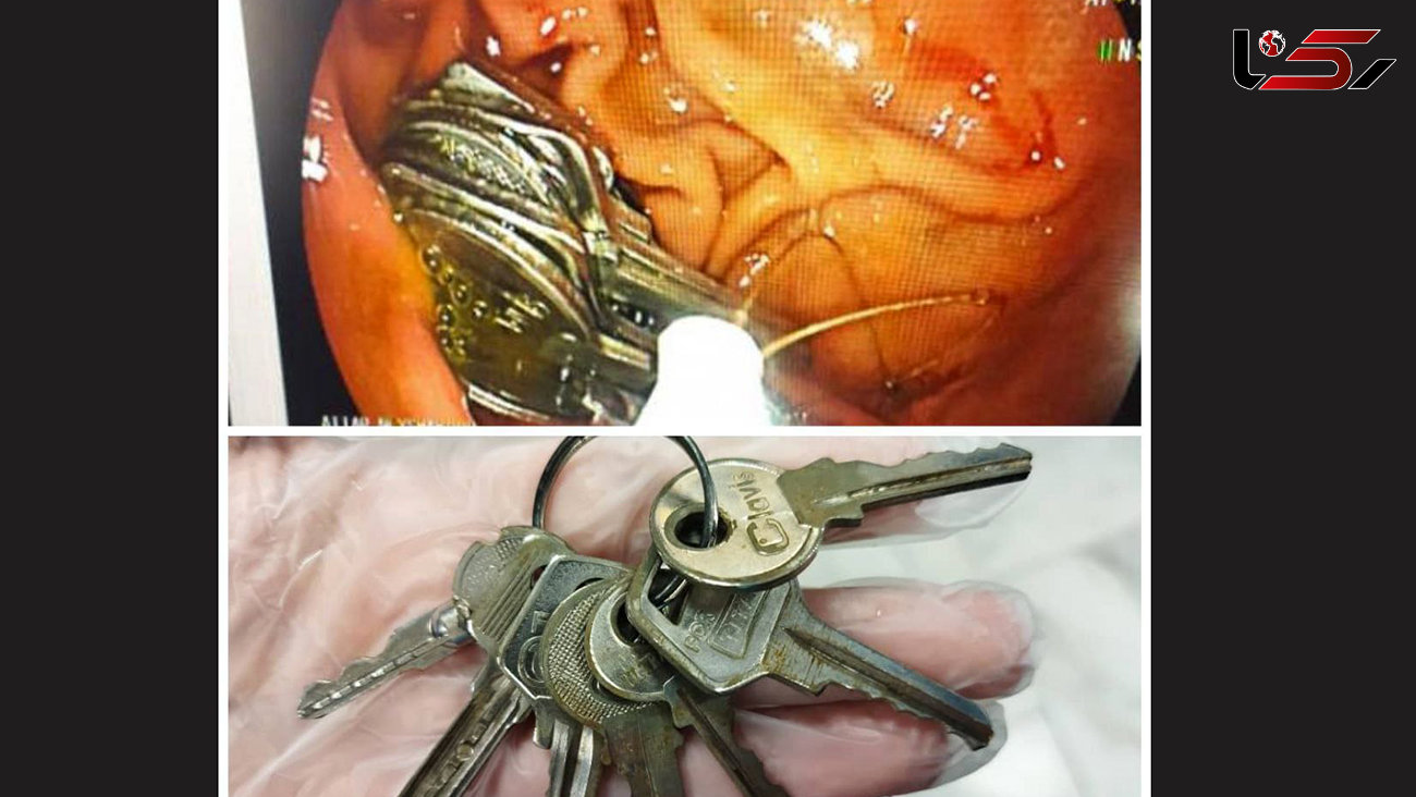 عکس عجیب از معده پر از کلید مرد نیشابوری / دسته کلید گمشده در معده اش پیدا شد