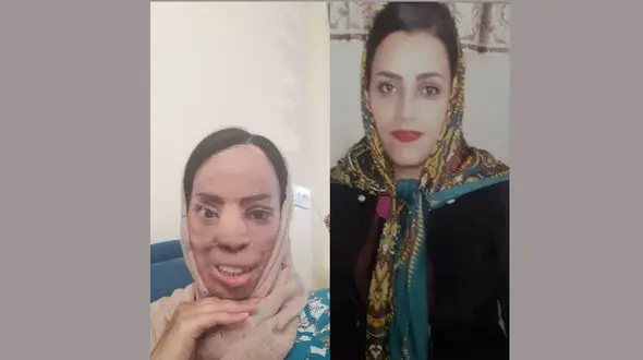 فاطمه زنی زیبارو بود که همسر برادرش سیمای او را از بین برد+ عکس دردناک