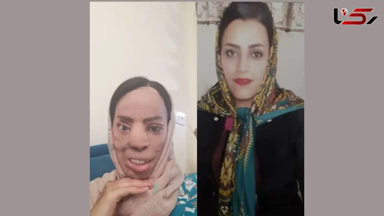 فاطمه زنی زیبارو بود که همسر برادرش سیمای او را از بین برد+ عکس دردناک
