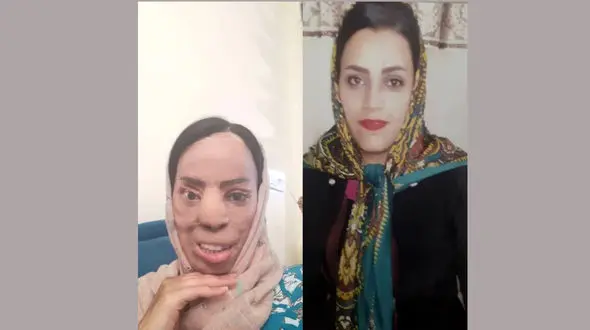 فاطمه زنی زیبارو بود که همسر برادرش سیمای او را از بین برد+ عکس دردناک