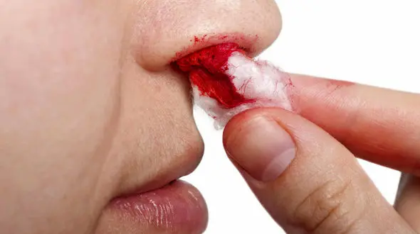 چرا خون دماغ می شویم؟ / درمان خونریزی بینی