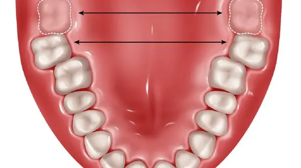 چرا باید دندان عقل را کشید؟