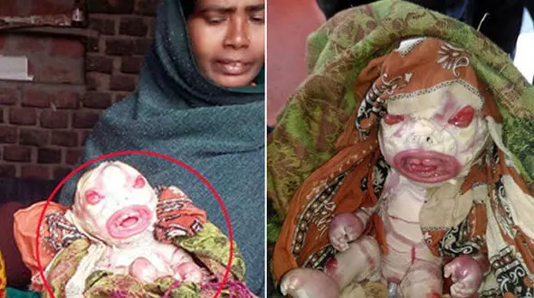 چرا این نوزاد را نفرین‌شده می دانند؟+ (عکس16+) 