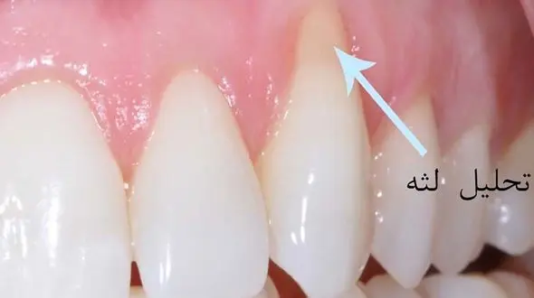 درمان پزشکی و خانگی عقب نشینی لثه