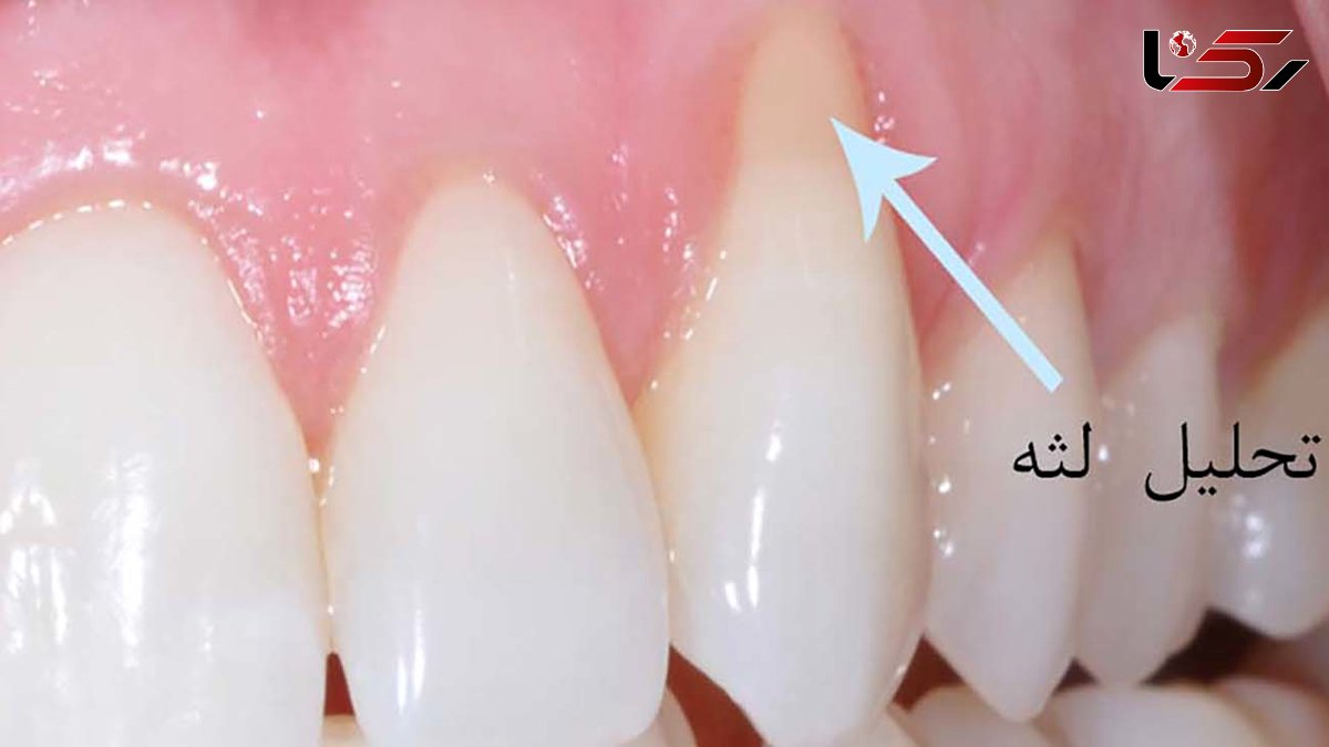 درمان پزشکی و خانگی عقب نشینی لثه