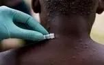 عملکرد وزارت بهداشت برای مقابله با "آبله میمون" ناامید کننده است / آمریکا و روسیه، واکسن مهارکننده را دارند + فیلم