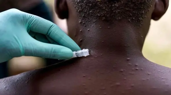 عملکرد وزارت بهداشت برای مقابله با "آبله میمون" ناامید کننده است / آمریکا و روسیه، واکسن مهارکننده را دارند + فیلم