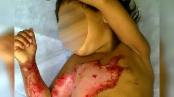 کودک آزاری دختر ۳ ساله با آب جوش/ امتناع والدین از درمان کودک