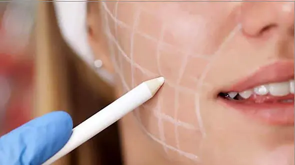 استفاده از سم بوتولینوم در آرایشگاه ها برای جوانسازی/ از فلج صورت تا اختلال در بینایی !