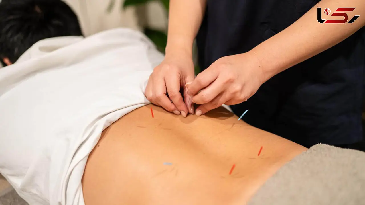 طب سوزنی برای سیاتیک؛ فواید، شواهد و عوارض احتمالی