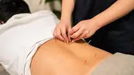 طب سوزنی برای سیاتیک؛ فواید، شواهد و عوارض احتمالی