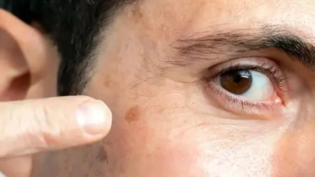 «آلودگی هوا فقط ریه‌ها را نمی‌زند؛ پوست هم قربانی خاموش دود و ذرات معلق»