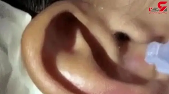 روش بیرون آوردن حشره از گوش