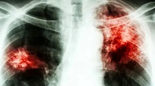 بیماری سل: علائم، روش‌های پیشگیری و درمان / مقاله علمی