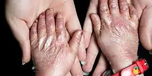 بیماری پروانه‌ای ارتباطی با ازدواج فامیلی دارد؟