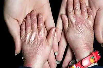 بیماری پروانه‌ای ارتباطی با ازدواج فامیلی دارد؟