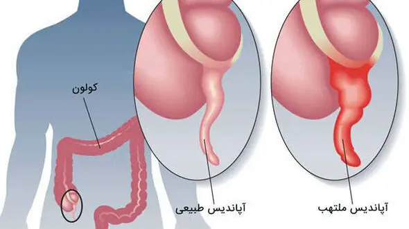 نشانه های هشداردهنده ابتلا به آپاندیس 