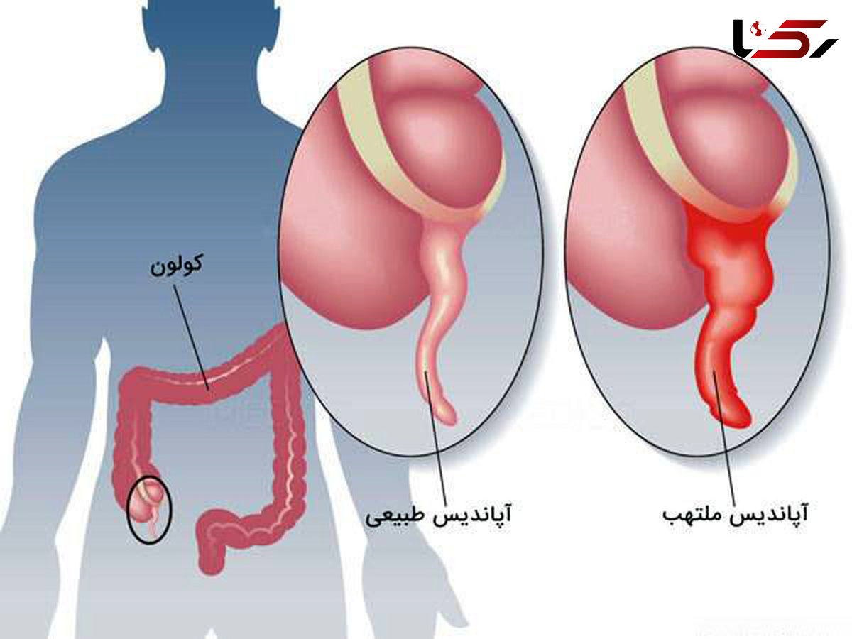 نشانه های هشداردهنده ابتلا به آپاندیس 