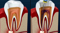 مراحل عصب کشی دندان + فیلم