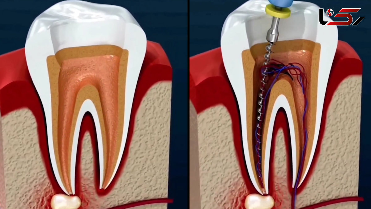مراحل عصب کشی دندان + فیلم