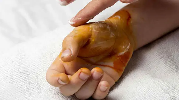 ببینید / سوختن ناگهانی بچه با روغن داغ