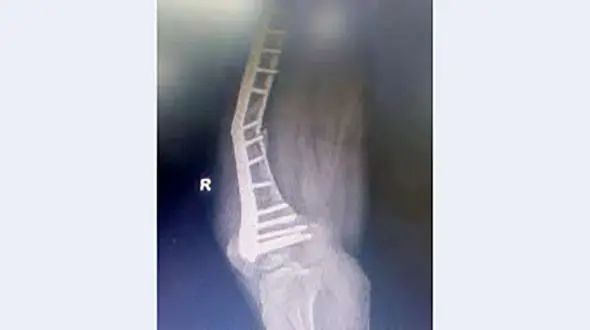 ماجرای  پلاتین های مشکوک بیمارستان نیشابور جنجالی تر شد / جوابیه علوم پزشکی و 10 سوال بی پاسخ خبرنگار