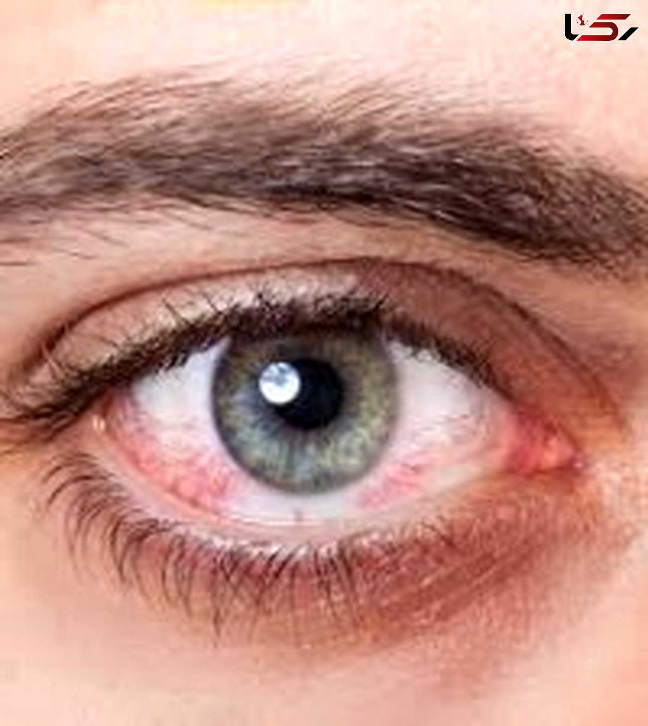 خوددرمانی آلرژی های چشمی ممنوع!