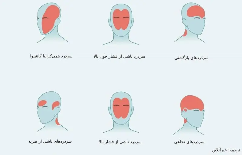 درد در نواحی مختلف سر ناشی از چیست؟/ از سردرد خوشه‌ای تا سردرد رعد و برقی+ تصاویر