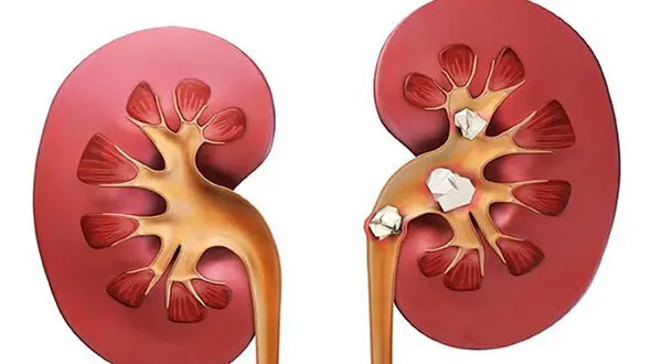 افسرده ها در معرض نارسایی کلیه