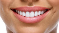 کامپوزیت دندان چگونه است؟ + فیلم
