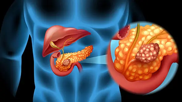 نشانه های بیماری های لوزالمعده چیست؟