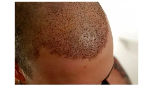 همه آنچه باید درباره کاشت مو بدانید