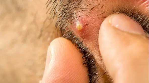 راه های پیشگیری و درمان کورک پوست / خطر مرگ با کورک