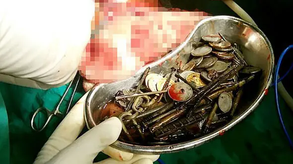 خارج کردن 7 کیلوگرم انواع سکه و میخ از شکم مقصودخان!+ تصاویر