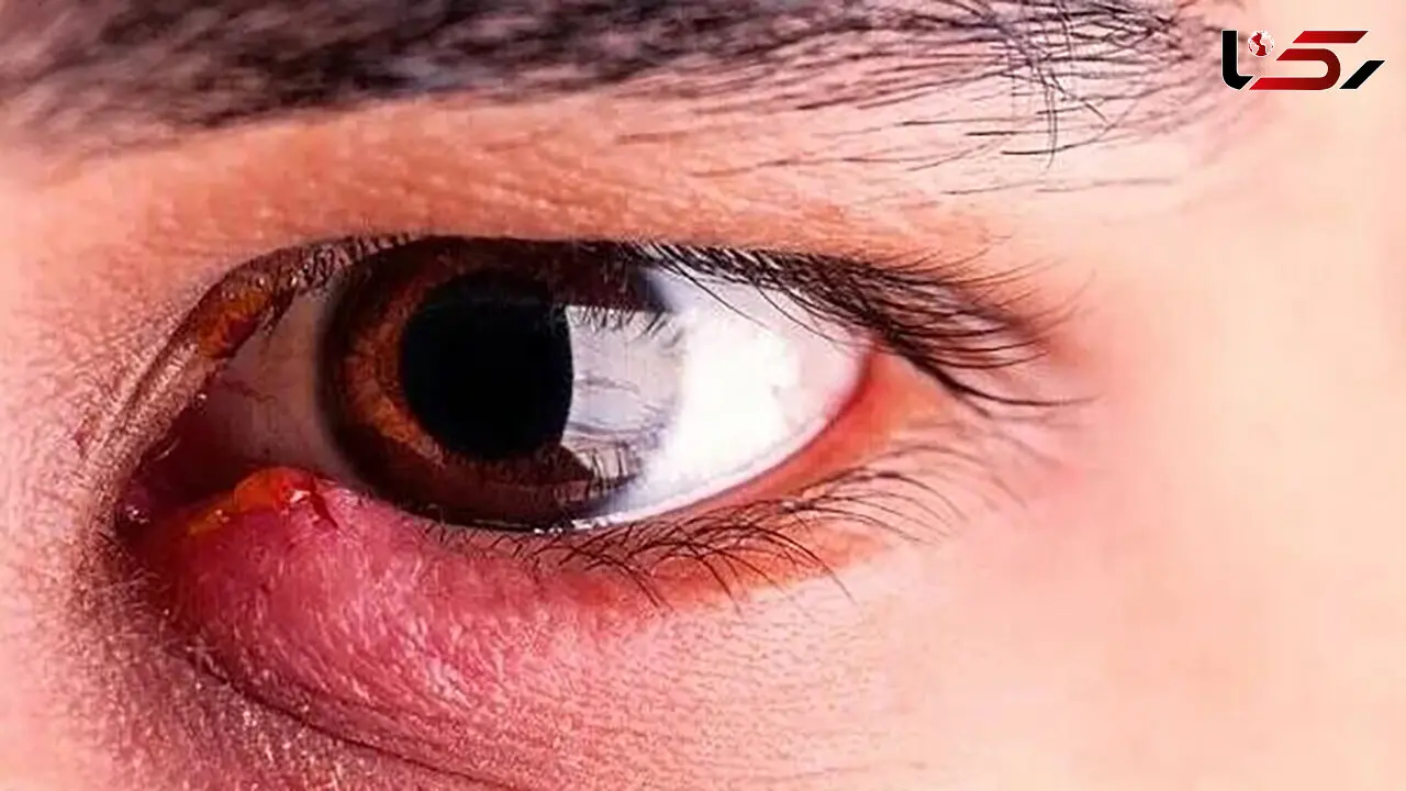 گل‌ مژه دارید؟ این نکات ساده درمان را سریع‌ تر می‌ کند