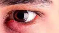 گل‌ مژه دارید؟ این نکات ساده درمان را سریع‌ تر می‌ کند