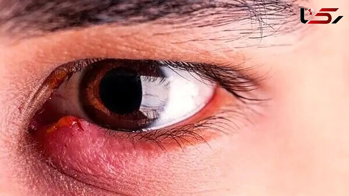 گل‌ مژه دارید؟ این نکات ساده درمان را سریع‌ تر می‌ کند