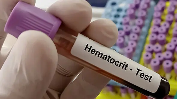 hematocrit چیست؟ / نحوه انجام آزمایش هماتوکریت + جدول