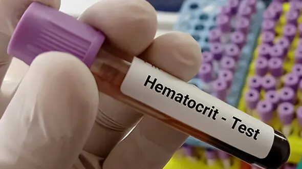 hematocrit چیست؟ / نحوه انجام آزمایش هماتوکریت + جدول